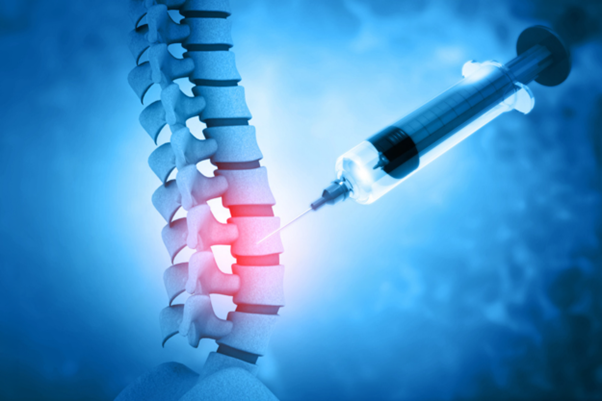 Epidural Steroid Injections