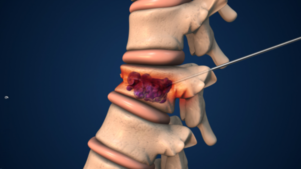 Kyphoplasty Treatment