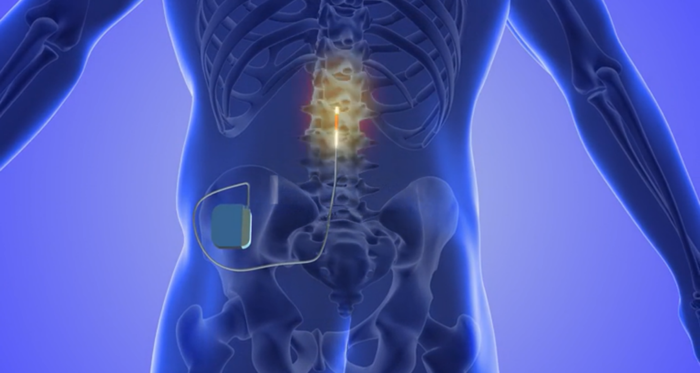 Spinal Cord Stimulation 